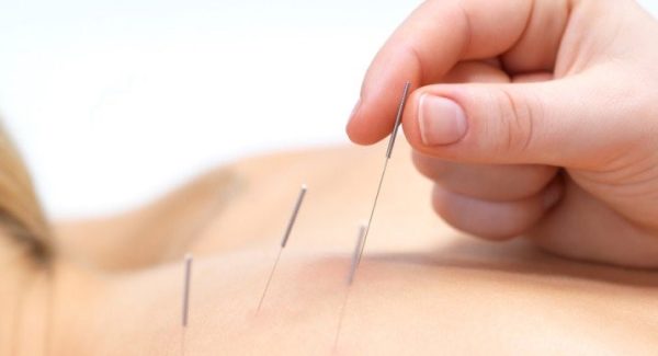 dryneedling